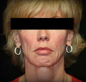 In-Office Facelift before 1108611