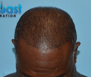 45-54 year old man treated with FUE Hair Transplant after 3624440