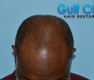 45-54 year old man treated with FUE Hair Transplant before 3624440