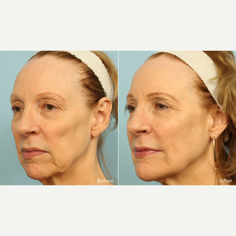 55-64 year old woman treated with Voluma before 3220101