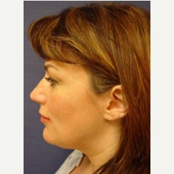 35-44 year old woman treated with Thread Lift before 2079291