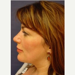 35-44 year old woman treated with Thread Lift after 2079291