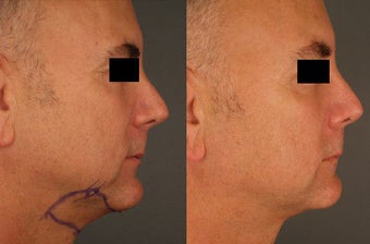 Chin / Neck Liposuction before 996364