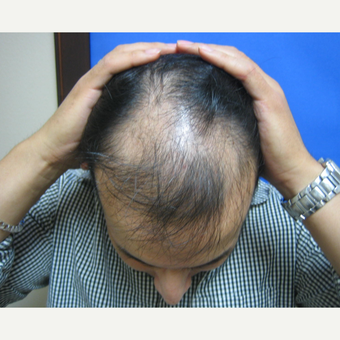 45-54 year old woman treated with Hair Transplant before 3664083