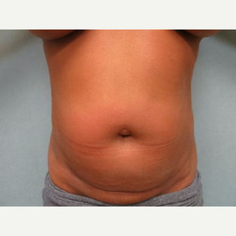 35-44 year old woman treated with Tummy Tuck before 3300119