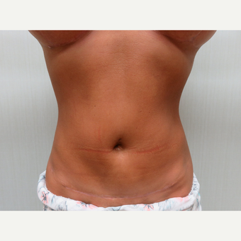35-44 year old woman treated with Tummy Tuck after 3300119