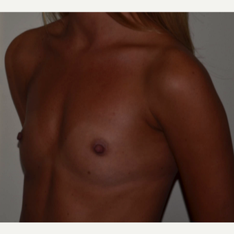 325cc Moderate Plus Profile Silicone Cohesive Gel Implants before 3840009