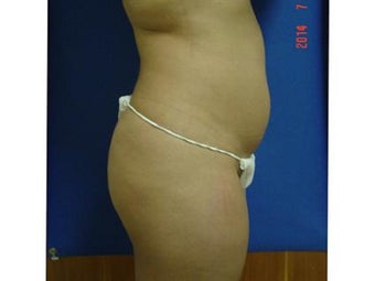 Brazilian Butt Lift 1493373
