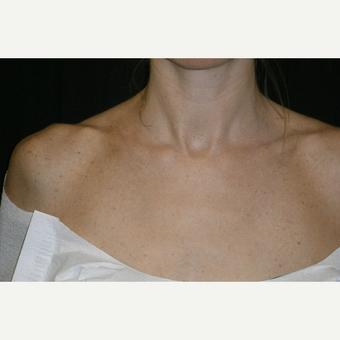 35-44 year old woman treated with IPL after 3125301