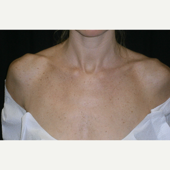 35-44 year old woman treated with IPL before 3125301