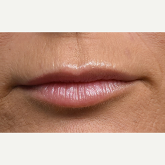 35-44 year old woman treated with Lip Augmentation before 3792018
