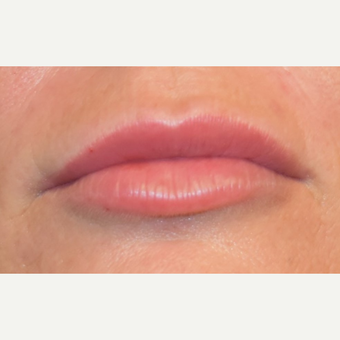 35-44 year old woman treated with Lip Augmentation after 3792018