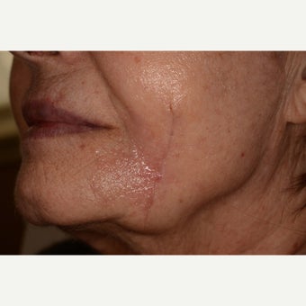 Large facial melanoma excision after 1747606