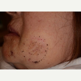 Large facial melanoma excision before 1747606