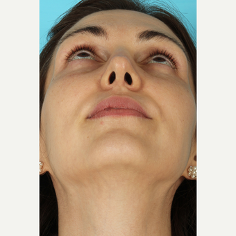 25-34 year old woman treated with Rhinoplasty after 3690829