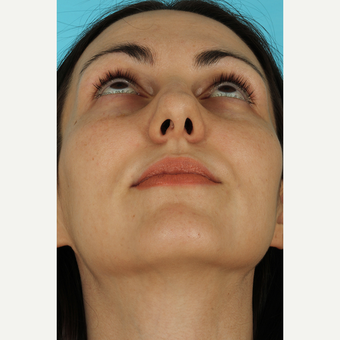 25-34 year old woman treated with Rhinoplasty before 3690829