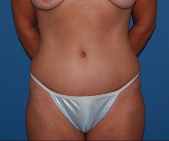 35-44 year old woman treated with Panniculectomy after 3542842