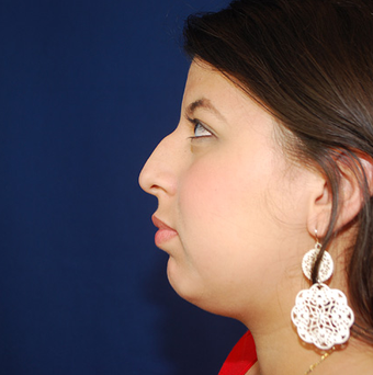 Chin Augmentation before 944860
