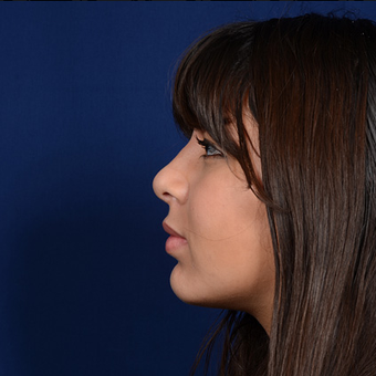 Chin Augmentation after 944860