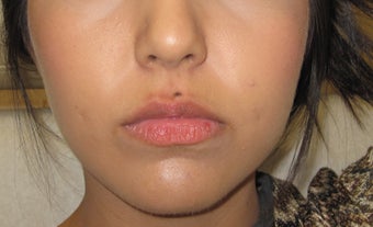 Mole removal using plastic surgery techniques before 1290172