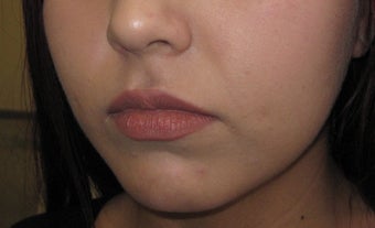 Mole removal using plastic surgery techniques 1290172