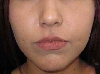 Mole removal using plastic surgery techniques after 1290172