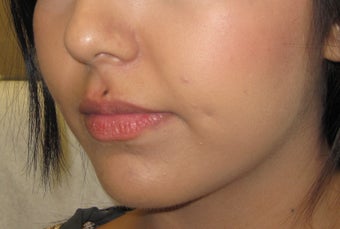 Mole removal using plastic surgery techniques 1290172