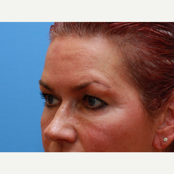 55-64 year old lady treated with Upper Eyelid Lift. before 3373019
