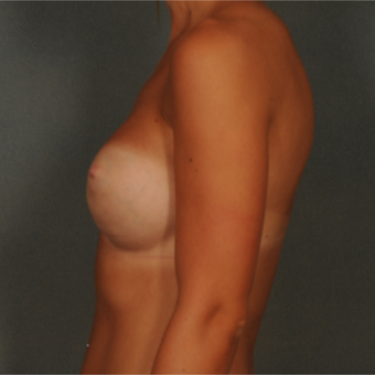 18-24 year old woman treated with Breast Implants after 3583115