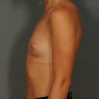 18-24 year old woman treated with Breast Implants before 3583115