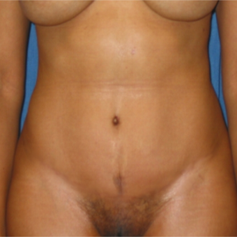 Tummy Tuck on 35 year old mother of 2 after 3259196