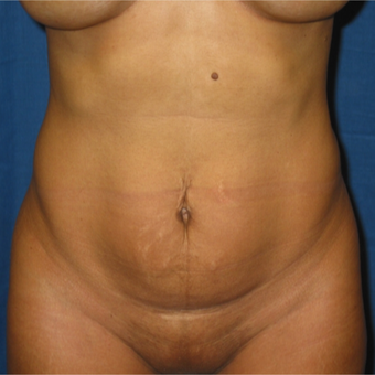 Tummy Tuck on 35 year old mother of 2 before 3259196