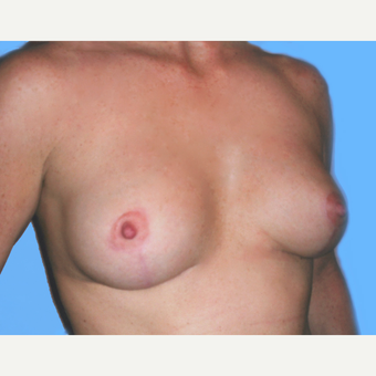 Breast Lift with Implants after 3748928