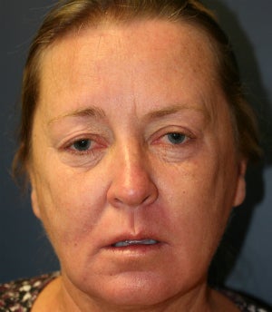 Eyelid blepharoplasties to open upper eyelids before 845415