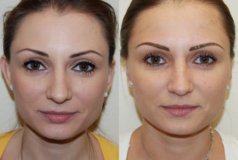 Otoplasty Surgery. before 1075795
