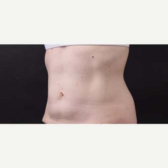49 year old woman treated with CoolSculpting after 3630240