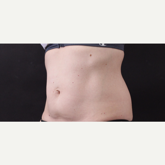 49 year old woman treated with CoolSculpting before 3630240