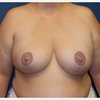 44 year old woman treated with DIEP flap Breast Reconstruction after 3383417