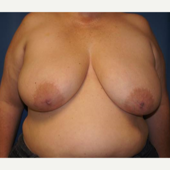 44 year old woman treated with DIEP flap Breast Reconstruction before 3383417