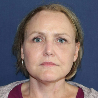Upper Eyelid Lift with Bellafill to lower lids and lower facelift after 3775436