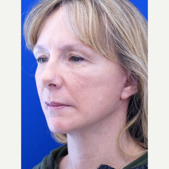 45-54 year old woman treated with Facelift after 3653507