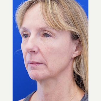 45-54 year old woman treated with Facelift before 3653507