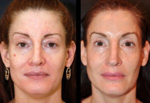 49 year old female following 1 session of Sculptra after 1427633