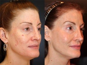 49 year old female following 1 session of Sculptra before 1427633