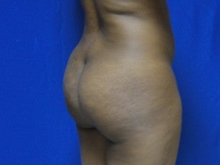 32 year old Brazilian Butt Lift - 2nd view before 1069858