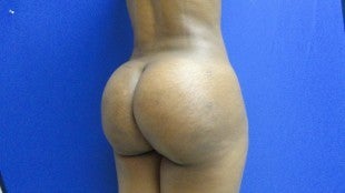 32 year old Brazilian Butt Lift - 2nd view after 1069858