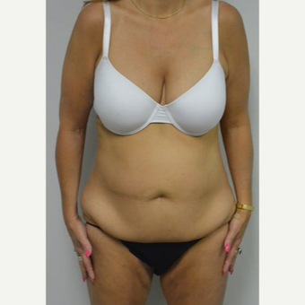 45-54 year old woman treated with Tummy Tuck Revision before 2894408