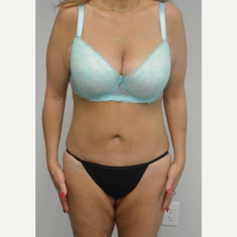 45-54 year old woman treated with Tummy Tuck Revision after 2894408