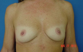 47 Year Old Woman Treated for Loss of Volumne in Breasts before 1115686