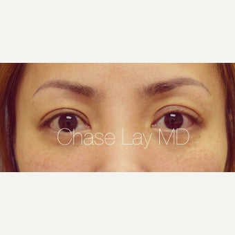 25-34 year old woman treated with Asian Eyelid Surgery and ptosis repair after 2574254